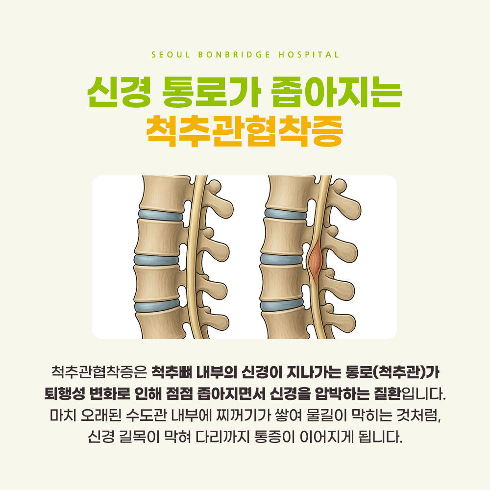 척추협착증 3