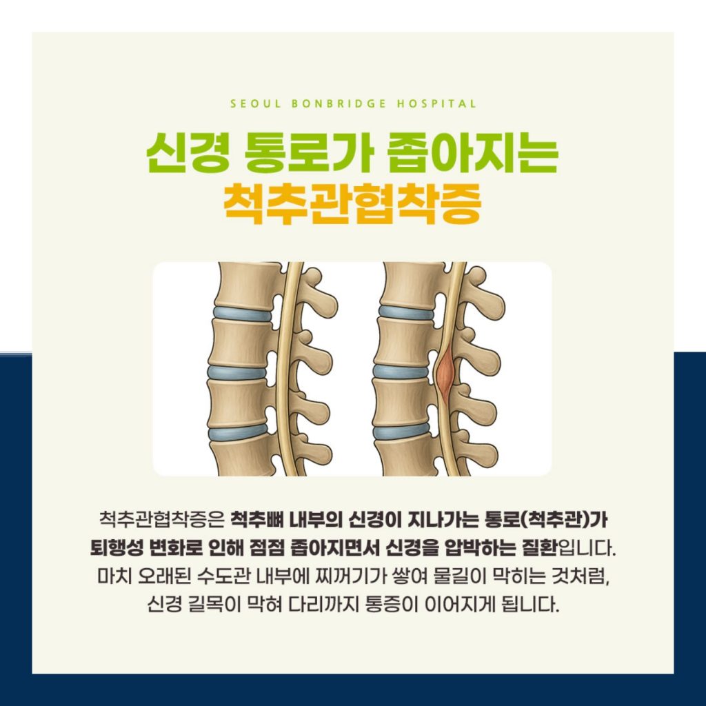 신경 통로가 좁아지는 척추관협착증